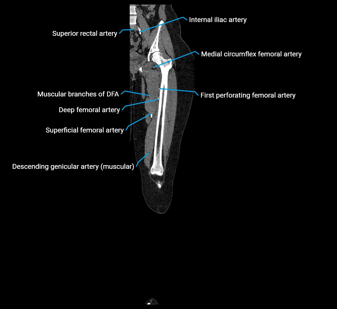 CTA lower limb coronal cross sectional anatomy labelled image _34 (2).webp